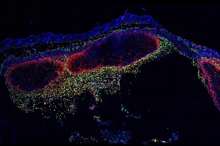 A highly magnified view of melanoma tumours growing in the skin. CD169+ macrophages are shown in green and yellow, forming a biological boundary wall to contain the tumours. Image courtesy Garvan Institute of Medical Research