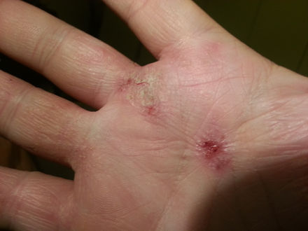 Atopic dermatitis has significant impact on mood in older patients