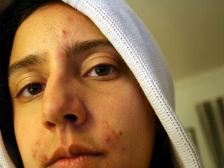 Allergic reactions to OTC acne products prompt 3 updates by Health Canada