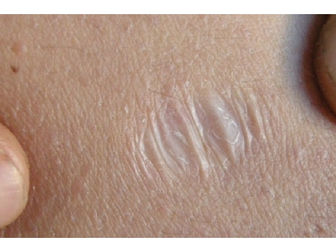 Topical pan-lysyl oxidase inhibitor studied for mature scars