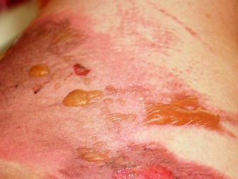 Topical 4-AP gel promising for burn wound closure