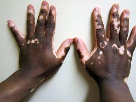 Immune checkpoints expressed in active, non-segmental vitiligo