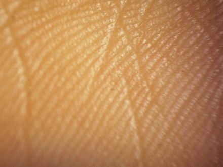 Skin cancer: Epidermal tissue may be more resilient to mutations