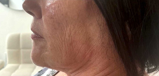 Lorna Cox Aesthetics, Port Glasgow, Facial aesthetics including SkinPen, polynucleotides and lip fillers
