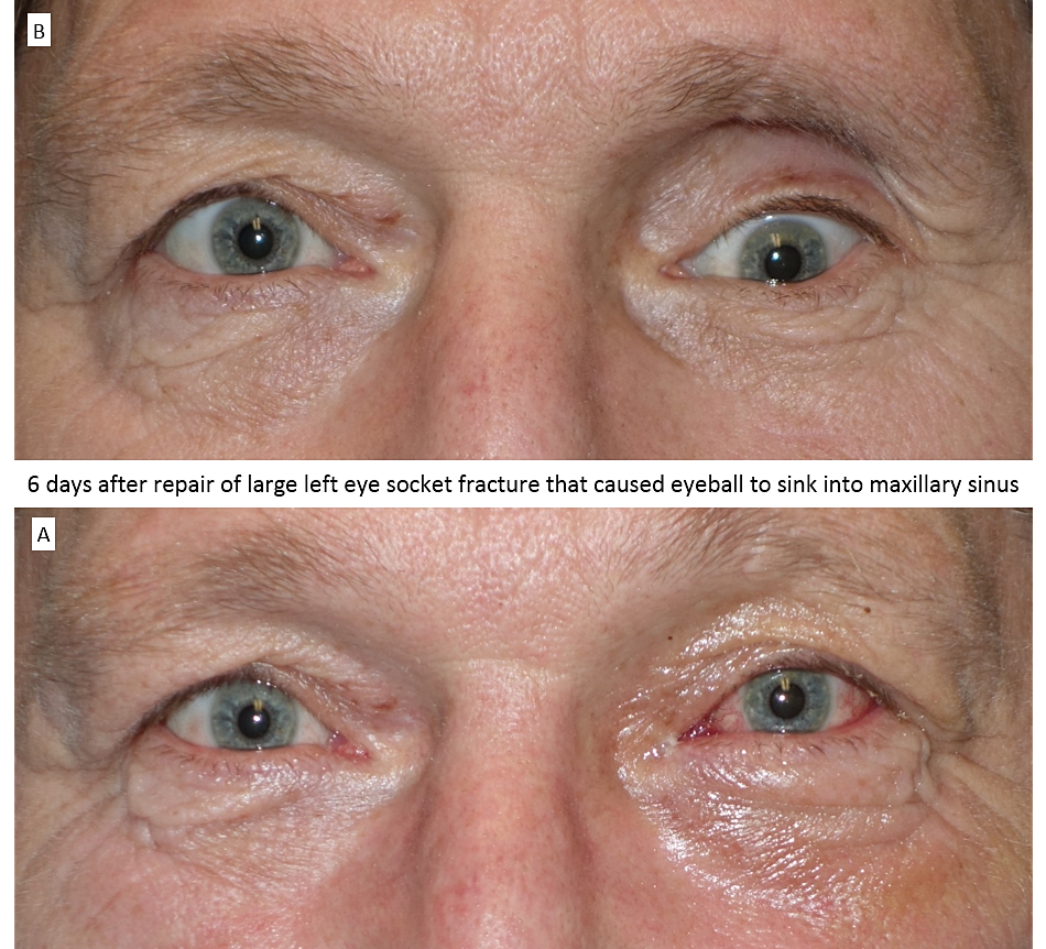 Plastic Surgeon Bellevue Pacific Oculofacial Plastic Surgery 6