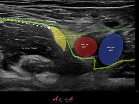 Femoral nerve block Ultrasound image
