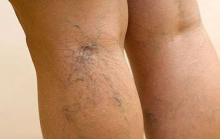 Telangiectasias: não é apenas tratar um vasinho!