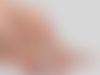 Tenho varizes, e agora?