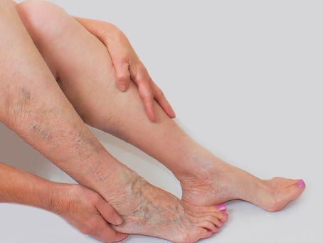 Tenho varizes, e agora?