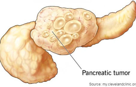 New symptoms associated to pancreatic cancer