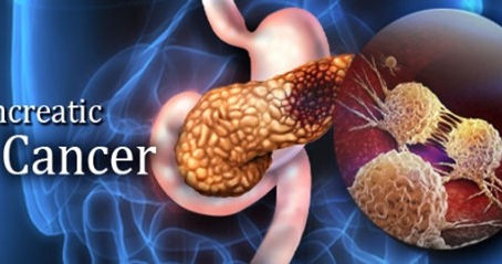 Keys for early diagnosis in hereditary pancreatic cancer