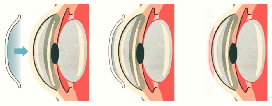 Moldea el epitelio corneal corrigiendo así tu graduación.