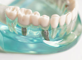 artificial tooth roots into jaw