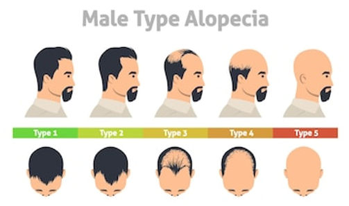 Types of Hair Loss