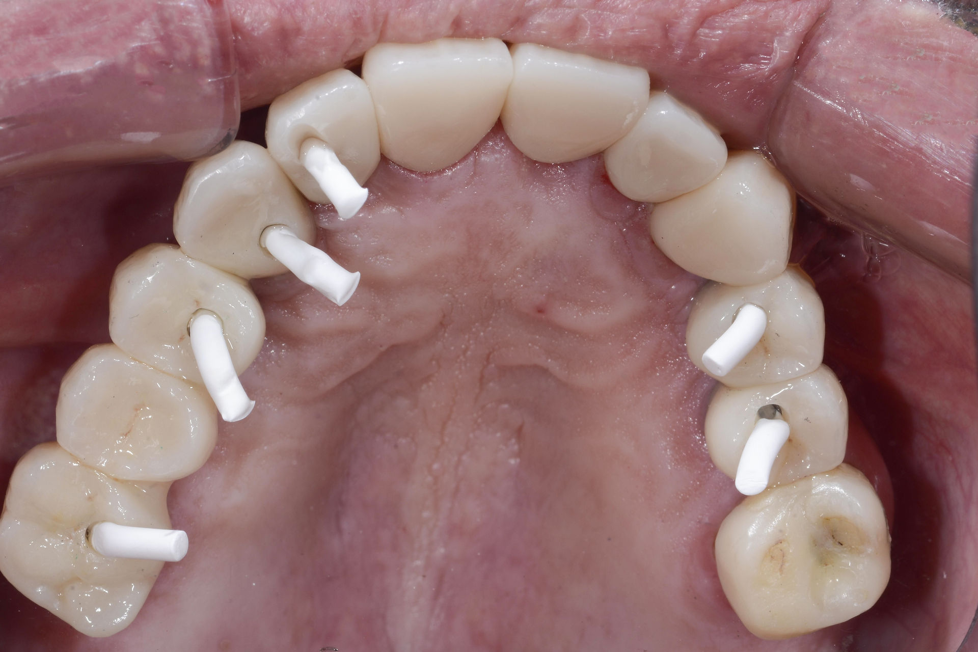This image shod patient's top jaw; FirstPlug Alpa 2.0 is placed inside each chanel
