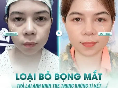 Cắt Mí Dưới Có Tác Dụng Gì? Giải Đáp Chi Tiết