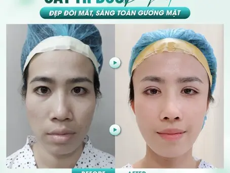 Cắt mí dưới giá bao nhiêu hiện nay?