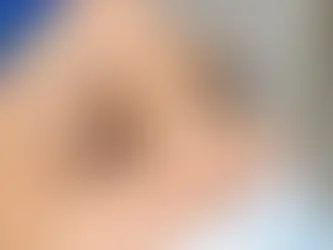 Cắt Bọng Mắt Giá Bao Nhiêu? Bảng Giá Chi Tiết