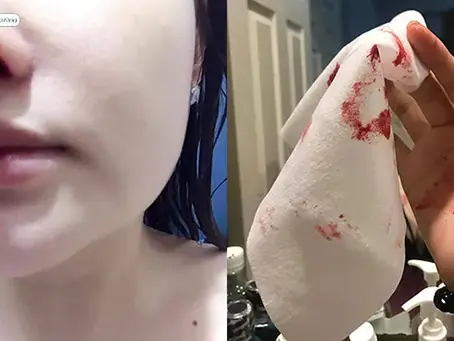 Nâng Mũi Xong Bị Chảy Máu: Nguyên Nhân, Cách Xử Lý