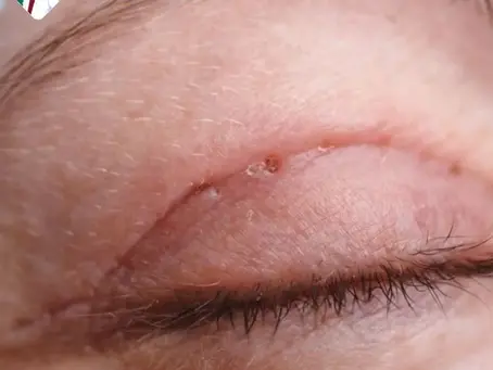 Cắt Mí Bị Sẹo Lồi: Nguyên Nhân, Cách Điều Trị và Phòng Ngừa