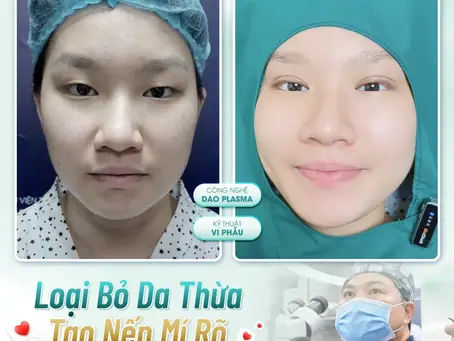 Nhấn Mí Plasma: Tất tần tật những điều bạn cần biết