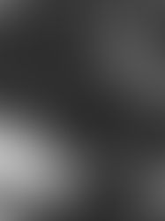 🔬 Uterine Fibroids