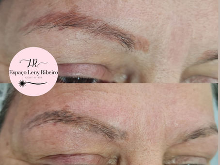 O laser remove pigmentos alaranjados?