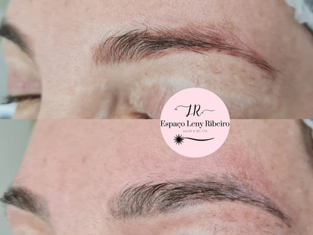 O laser remove pigmentos avermelhados?