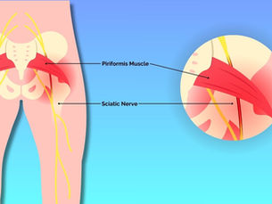 Piriformis Syndrome – A Pain in the A**