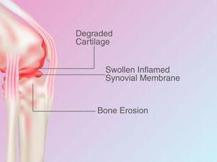 Can Physical Therapy Help with Rheumatoid Arthritis Symptoms?