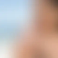 Can Sunscreen Sting? What Your Skin Is Telling You