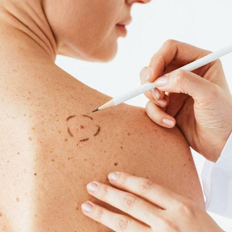cancer de la peau 