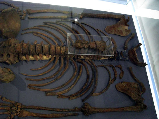 The Kebara 2 specimen, shown here riddled with chiropractic subluxations, would probably be alive today if they had access to a good chiropractor