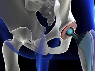 Direct Anterior Minimally Invasive Total Hip Replacement
