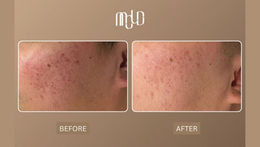 Over 100 Clients Successfully Treated for Acne Scars at Mold Manila Through Science-Led, Personalized Care