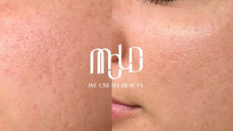 Acne Scar Treatment Options in the Philippines: What Medical Experts Say Works Best | MOLD Manila