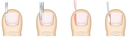 Nail-Surgery-600.jpg