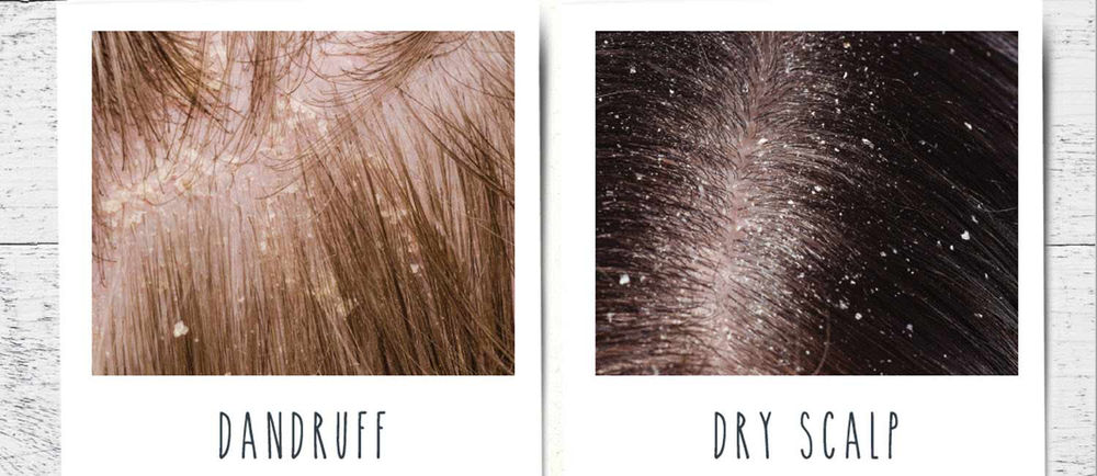 Dandruff vs Dry Scalp
