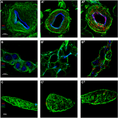 I depositi di globotriaosilceramide 3 sono specifici per la malattia di Fabry con mutazioni classich