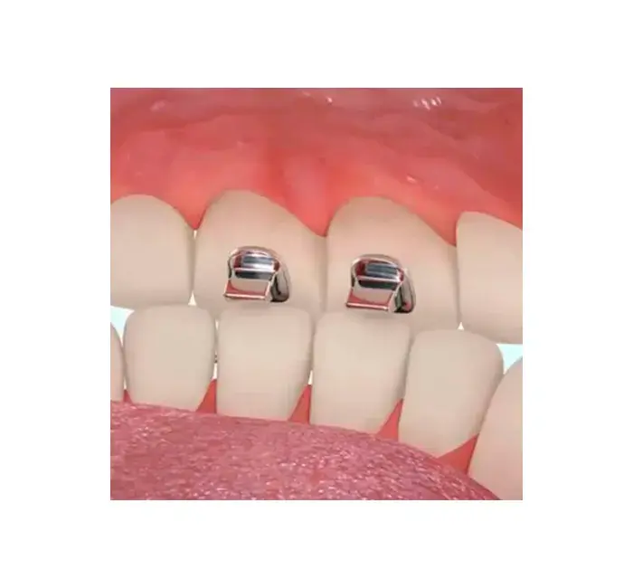 Bite Turbo Orthodontic Stop and Bite Guide 10 pcs