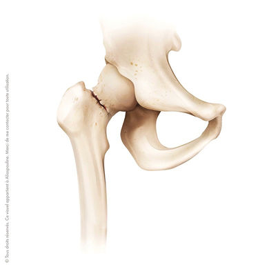 hanche-fracture-col-femur-docteur-core-chirurgien-orthopediste-hanche-genou-cheville-traum