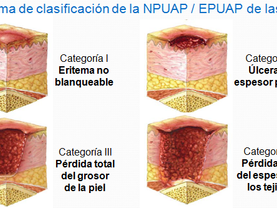 Guía para la prevención y tratamiento de UPP