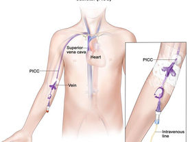 Mantenimiento de accesos venosos (lll): PICC