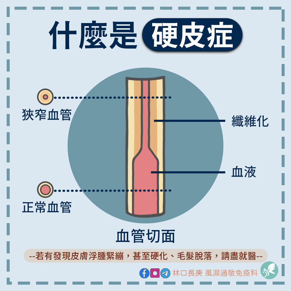 什麼是硬皮症 ️ | My Site