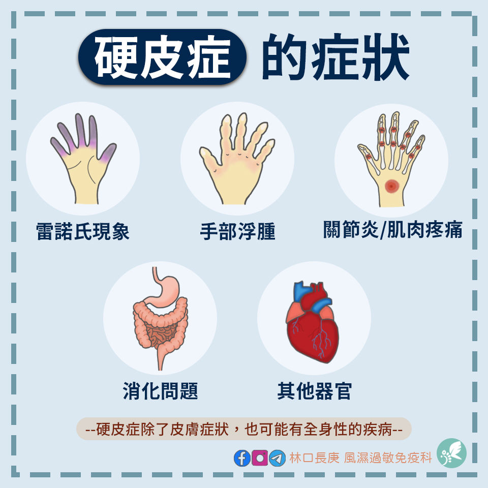 硬皮症的症狀 | My Site