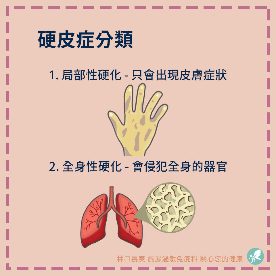 硬皮症的分類 | My Site