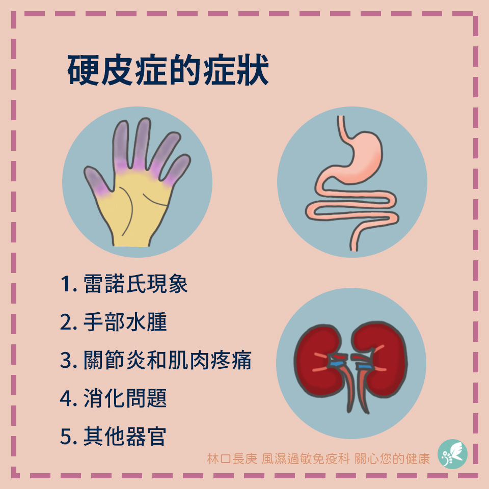 硬皮症的症狀 | My Site