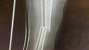 When Your Child Can't Tell You His Leg Is Badly Broken....
