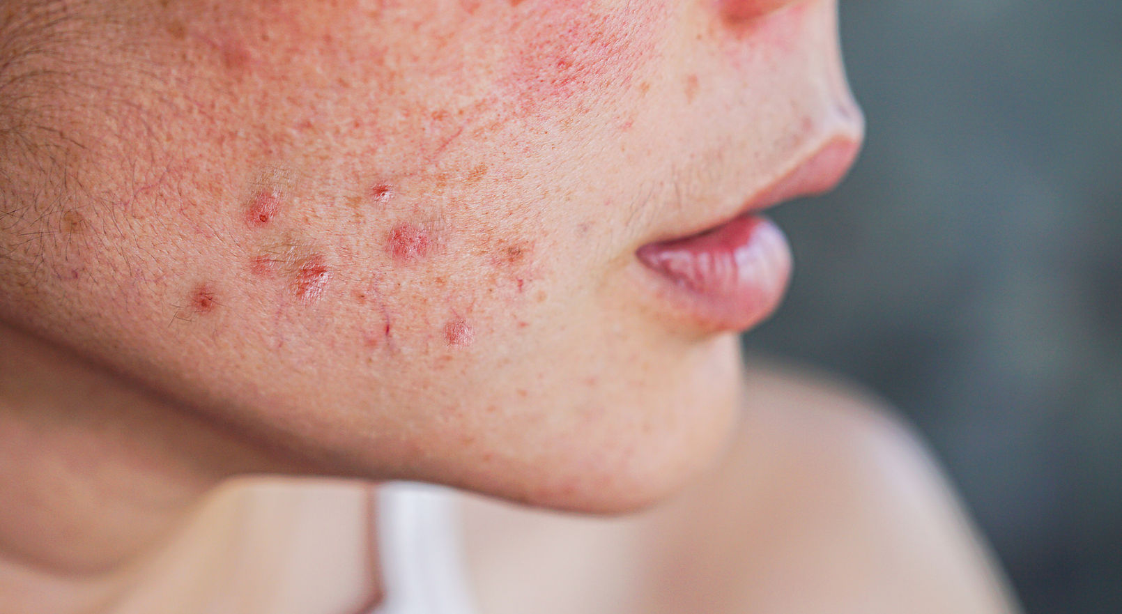 closeup acne on woman's face with rash skin, scar, and red skin syndrome allergic to cosme