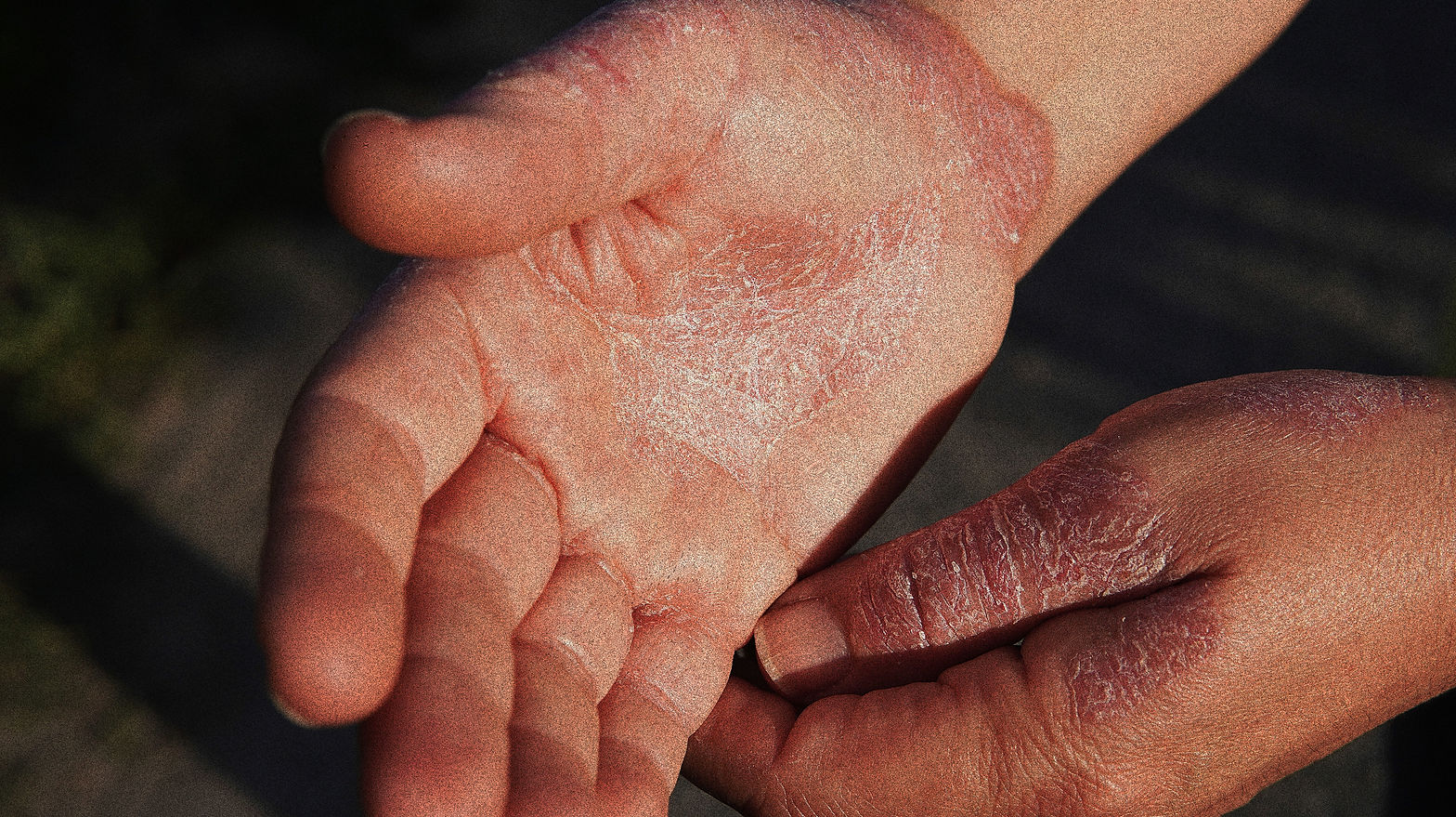 Skin rash caused by eczema Eczema on human skin - close-up dermatitis symptoms Skin diseas